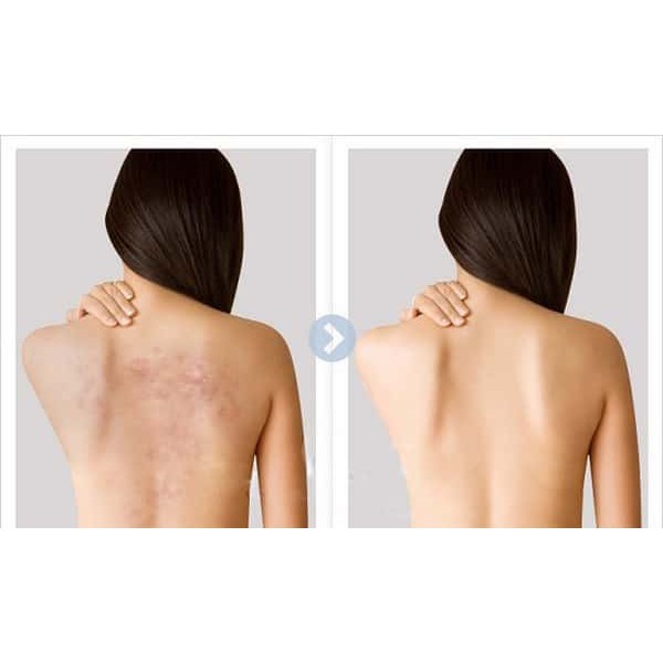 [NHIỀU LOẠI] Sản phẩm giúp giảm mụn lưng For Back