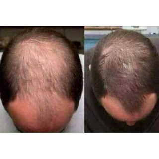 Xịt Kích Mọc Tóc, Giảm Rụng Tóc EKSIDERM