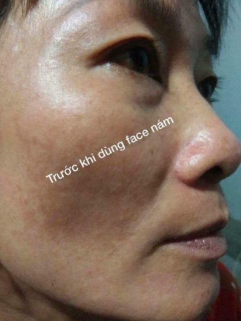 Kem nám, tàn nhan Queenie skin | BigBuy360 - bigbuy360.vn