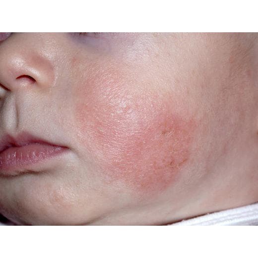 [Mẫu mới 2019] Kem dưỡng da chữa nẻ, chàm sữa Dexeryl 250g