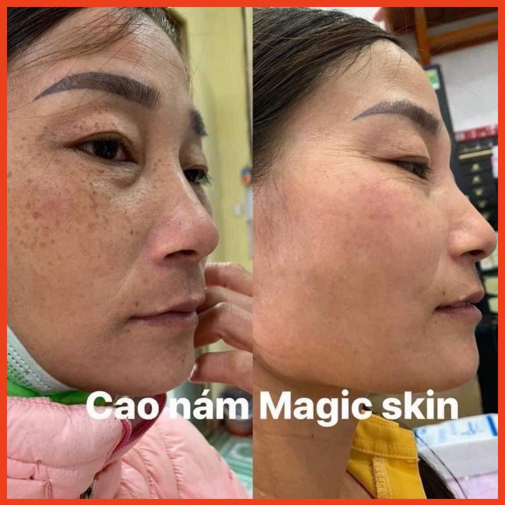 [CHÍNH HÃNG] Cao Nám Ngừa Nám Tàn Nhang Magic Skin ROYAL MELASMA PLUS 13/40g