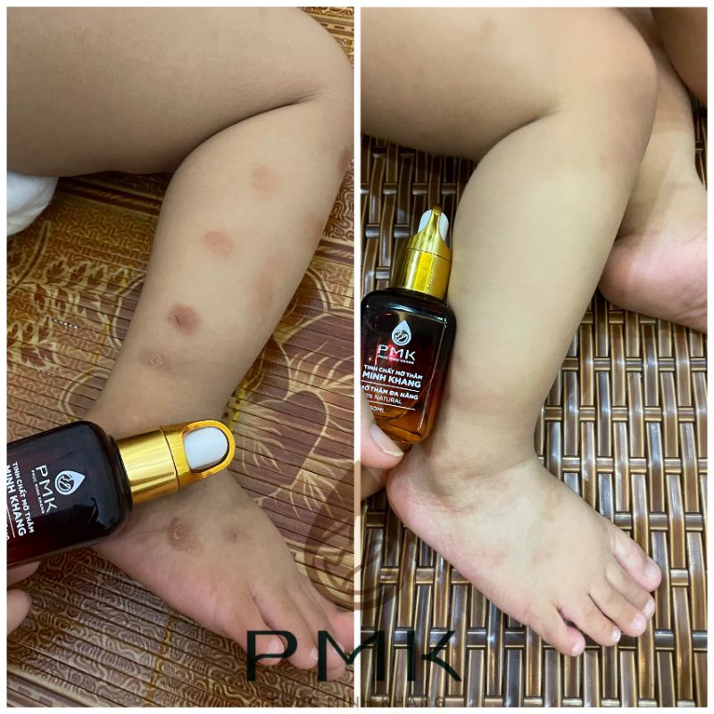 Tinh chất Xóa mờ thâm Minh Khang- Xoá thâm Sẹo,thâm mắt, thâm môi,thâm nách,thâm mụn,thâm gãi ngứa - Chính Hãng