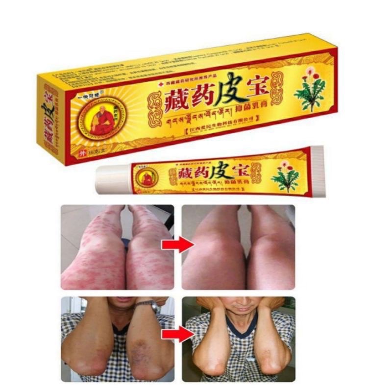 Kem bôi ngứa, lang, nấm, zona, hắc lào, ghẻ nước,nấm da đầu ,vẩy nến