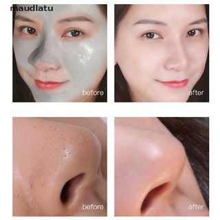 Mặt nạ bùn dưỡng ẩm kiểm soát dầu trị mụn trứng cá