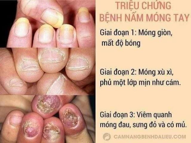 Kem bôi nấm móng tay chân CLOTHASONE-D CREAM 15g Thái Lan