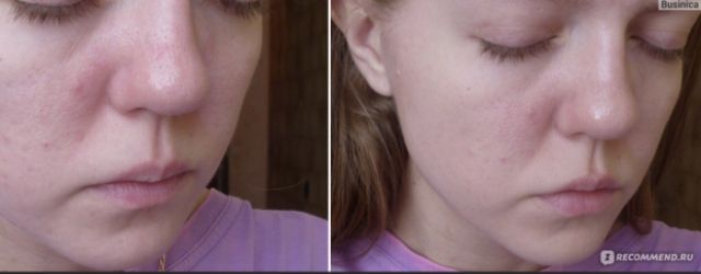 GEL LÔ HỘI loại bỏ mụn trứng cá, mụn đầu đen, li ti, mụn cám | BigBuy360 - bigbuy360.vn