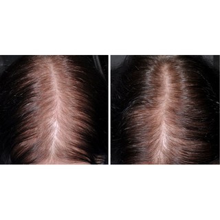 Minoxidil - Dung dịch hỗ trợ mọc tóc cho nam