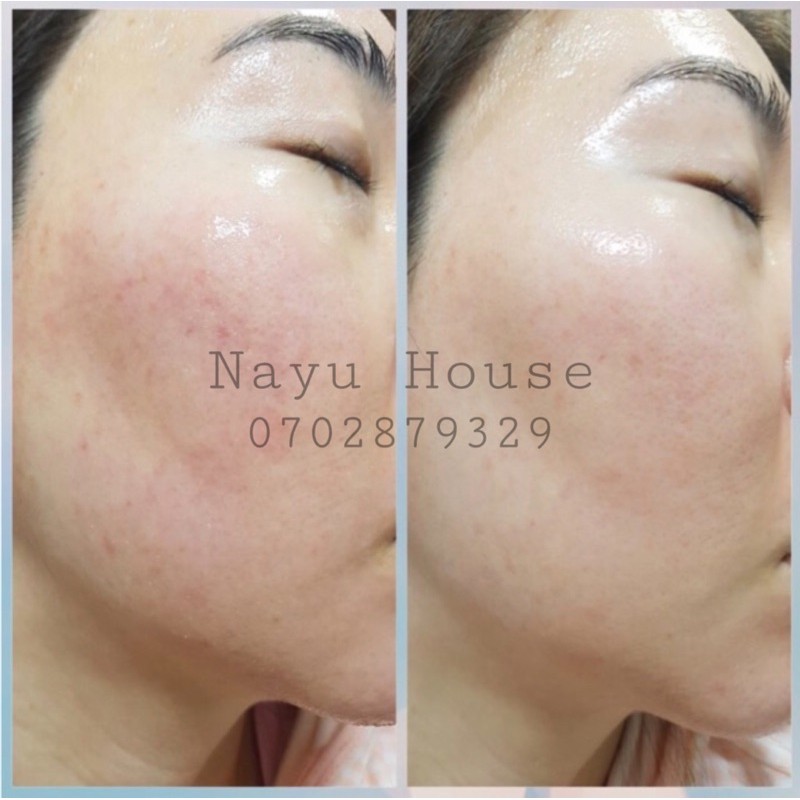 TINH CHẤT EGF EASYDEW | BigBuy360 - bigbuy360.vn