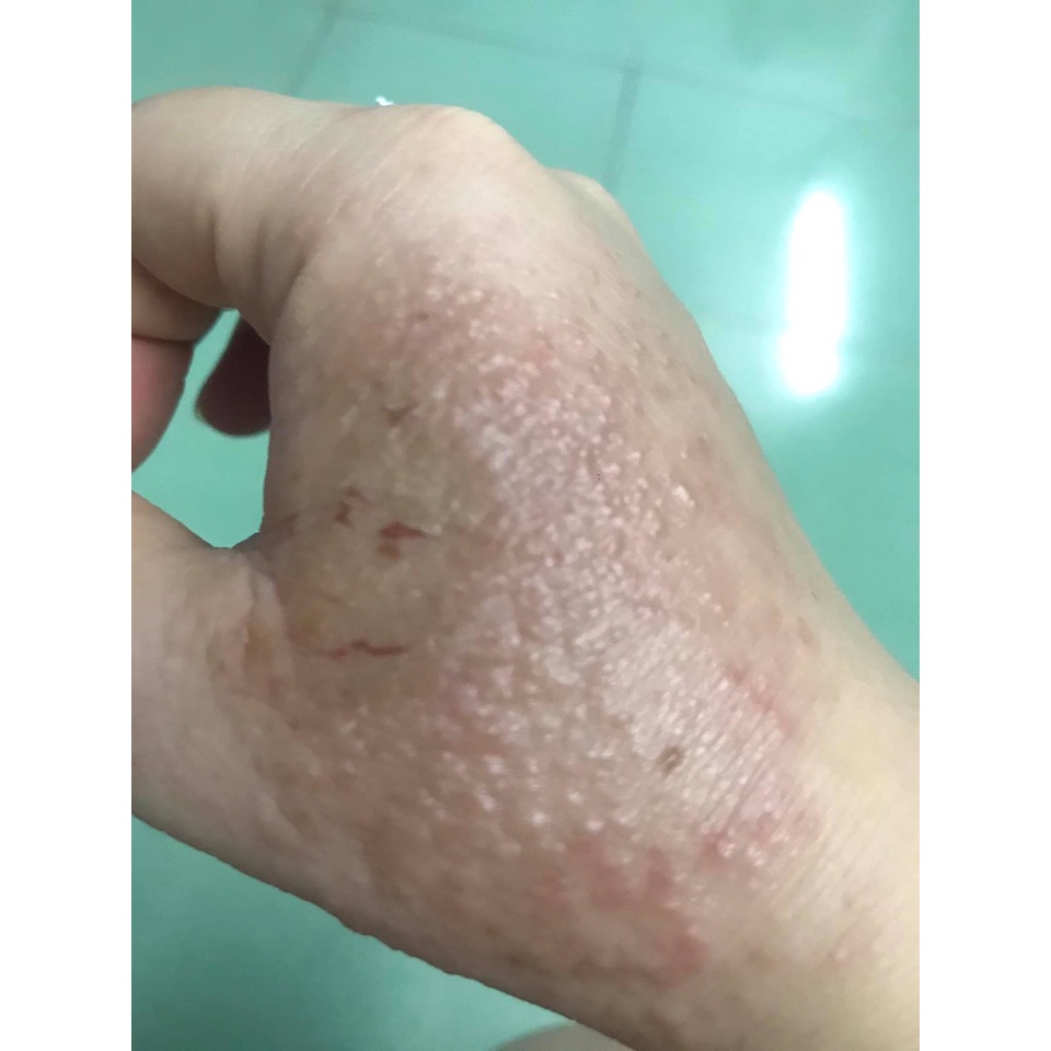 Kem bôi bọ cạp vàng vua các loại nấm ngứa hắc lào