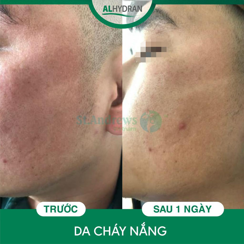 Kem dưỡng ẩm phục hồi tổn thương da Alhydran 15ml