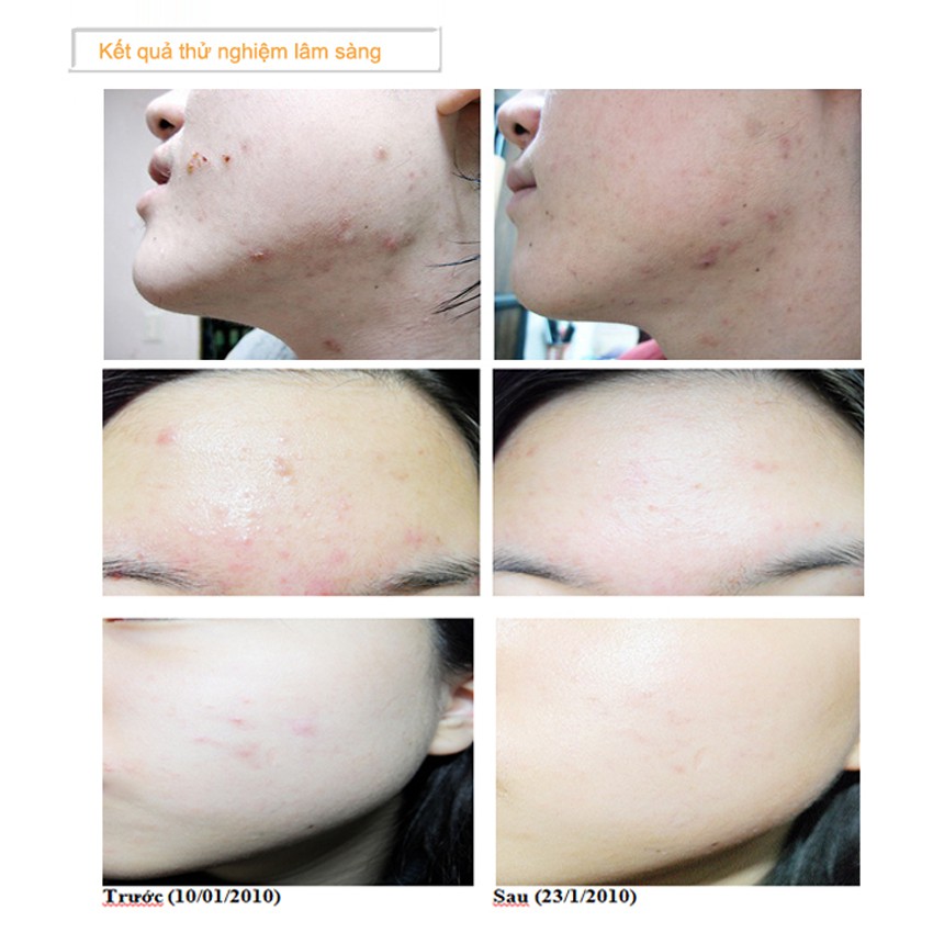 Sửa rửa mặt SNP Acsys dịu nhẹ cho da mụn và da nhạy cảm Cleansing Foam 180ml | BigBuy360 - bigbuy360.vn