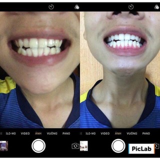 Miếng dán trắng răng Crest Whitestrips Supereme
