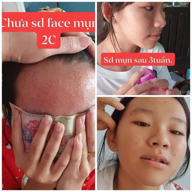 FACE MỤN 2C(mua 10tặng 1)