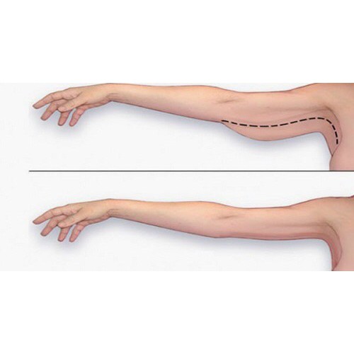 Gen định hình giảm mỡ bắp tay ⚡CAO CẤP⚡ áo nịt tay- vai 𝖠𝖭𝖭 𝖢𝖧𝖤𝖱𝖸 𝗋𝖾𝖿 3015 /Powernetline giúp bắp tay thon gọn