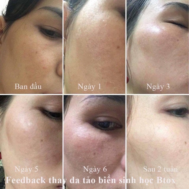 [CHÍNH HÃNG] Thay da sinh học Matrigen B-TOX PEEL Hàn Quốc 4 Màu ❤ Thay Da Sinh Học Vi Tảo BTox Peel Matrigen