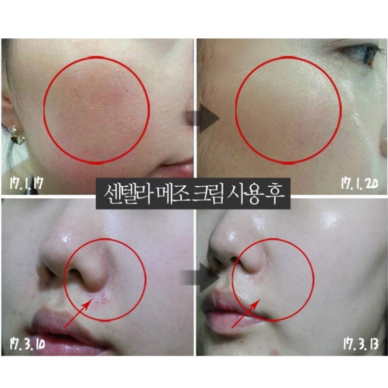 Kem dưỡng ngừa mụn MOON Kem dưỡng rau má Medi-peel Centella Fomula Mezzo Cream 30ml phục hồi làm dịu da mụn cấp tốc