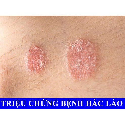 kem bôi nấm ngứa, hắc lào, mề đay, á sừng, viem da, nấm da