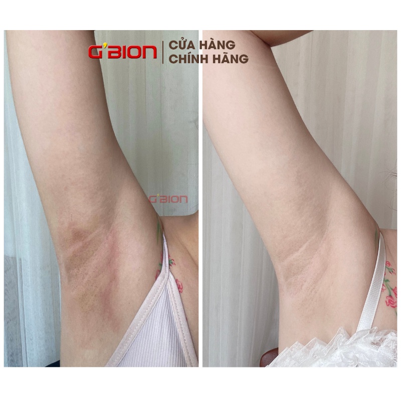 PEEL NÁCH LUXURY GIRL, THAY DA SINH HỌC KHỬ THÂM ( NÁCH, MÔNG, BẸN,ĐẦU GỐI, CÙI TRỎ ), NPP GBION