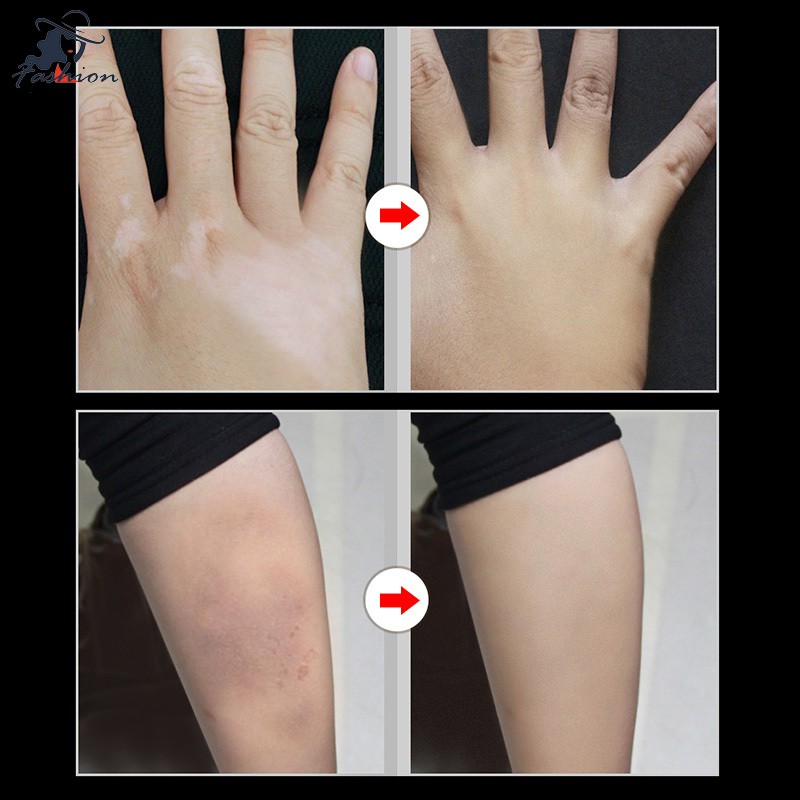 Bộ 2 kem che khuyết điểm/sẹo/hình xăm/vết bớt không gây đau đớn | BigBuy360 - bigbuy360.vn