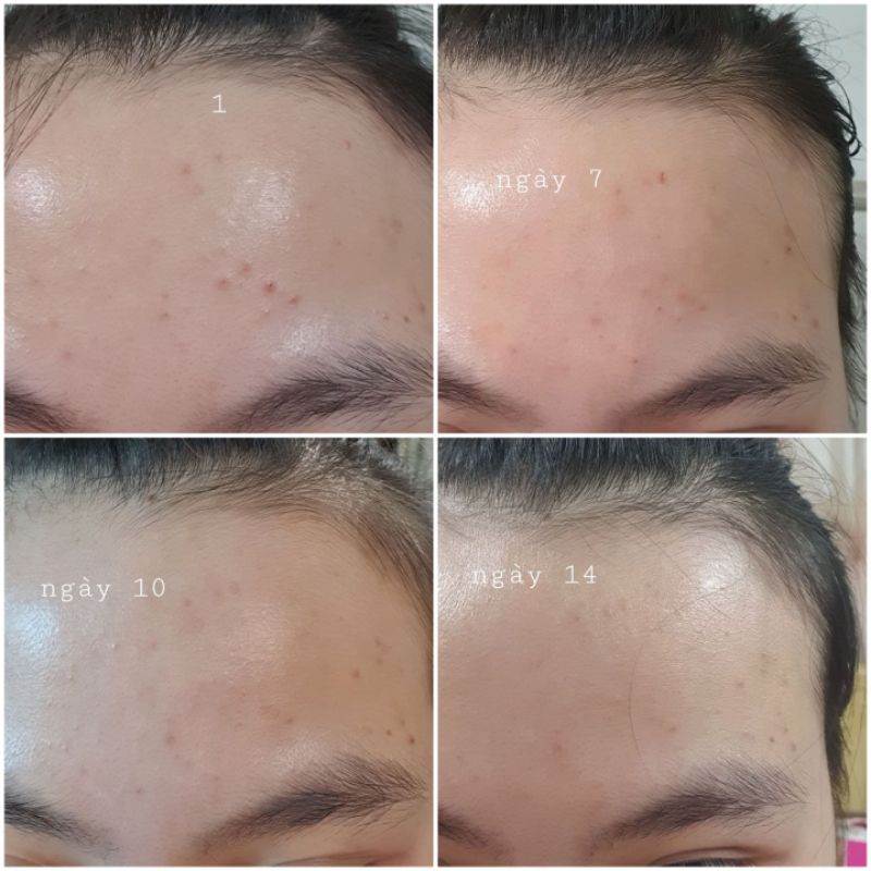 KEM DƯỠNG DÀNH CHO DA MỤN ONYX | BigBuy360 - bigbuy360.vn