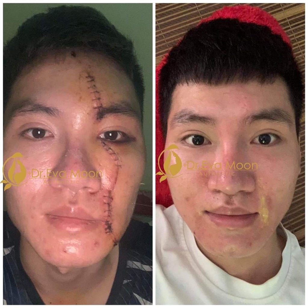 Kem mờ sẹo Gentacin, làm mờ sẹo lồi, sẹo rỗ, sẹo thâm EVA
