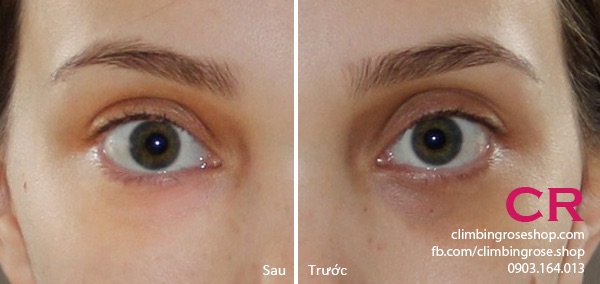 Kem ngừa thâm mắt Kumargic nhật bản | BigBuy360 - bigbuy360.vn