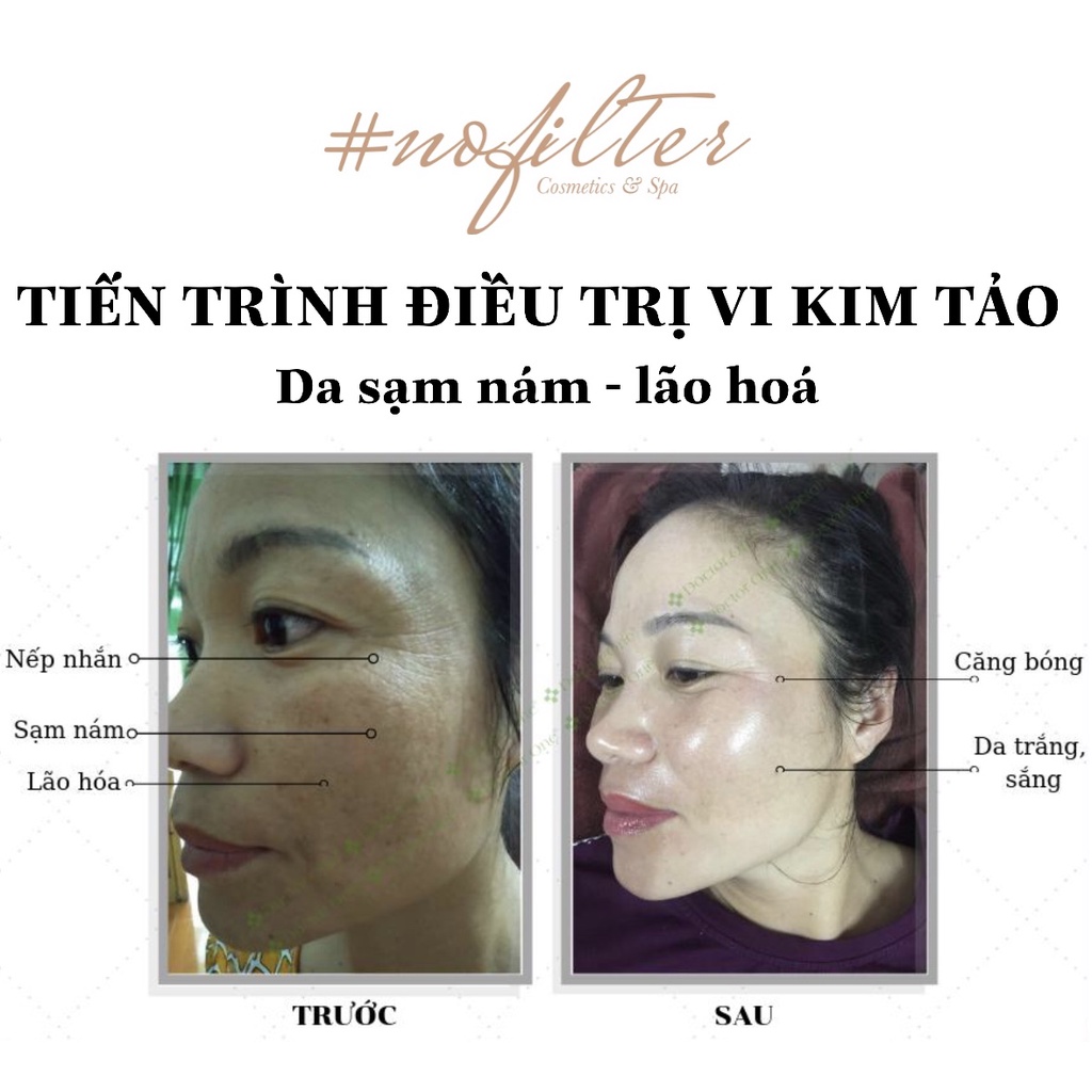 COMBO NÁM - Dưỡng trắng da, ngừa nám, tàn nhang hiệu quả Doctor One - Tặng vi kim tảo biển