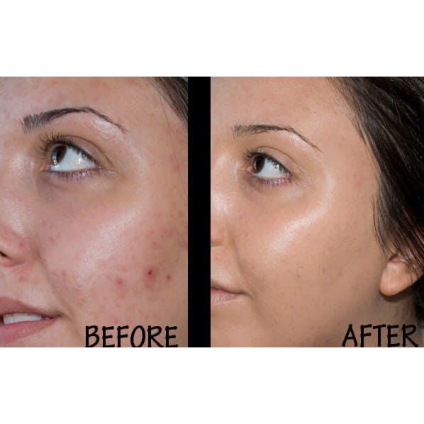 KEM NỀN TƯƠI NEUTROGEN