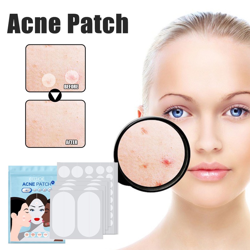 Miếng Dán Hỗ Trợ Giảm Mụn Nhiều Kích Cỡ Chống Thấm Nước Tránh Để Lại Sẹo