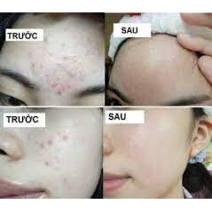 Gel Giảm Mụn, Mờ Thâm Gamma Megaduo 15g