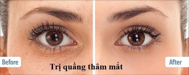 Kem Trị Nhăn Và Thâm Quầng Mắt Lựu Đỏ  20g