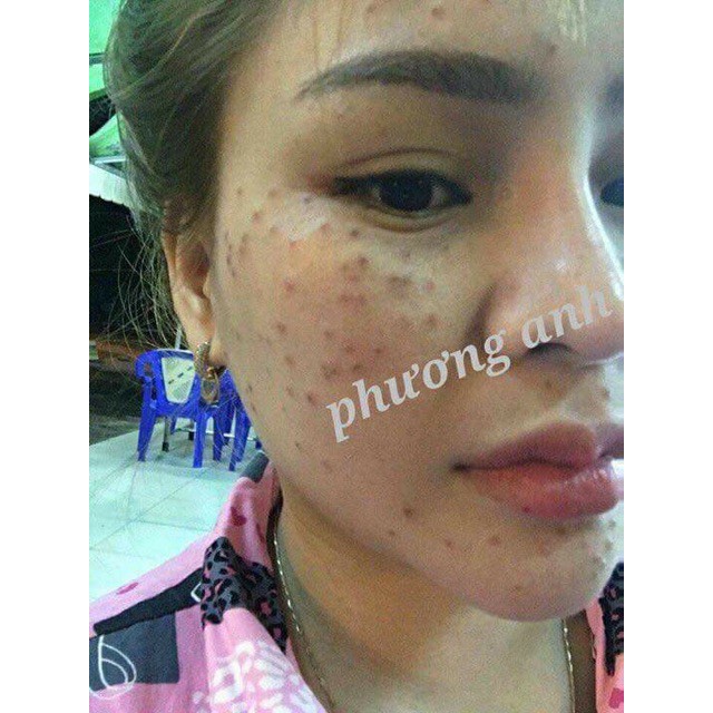 Chấm tàn nhang sẹo rỗ nám KHÔNG ĐAU Yody White Phương Anh - Mẫu mới