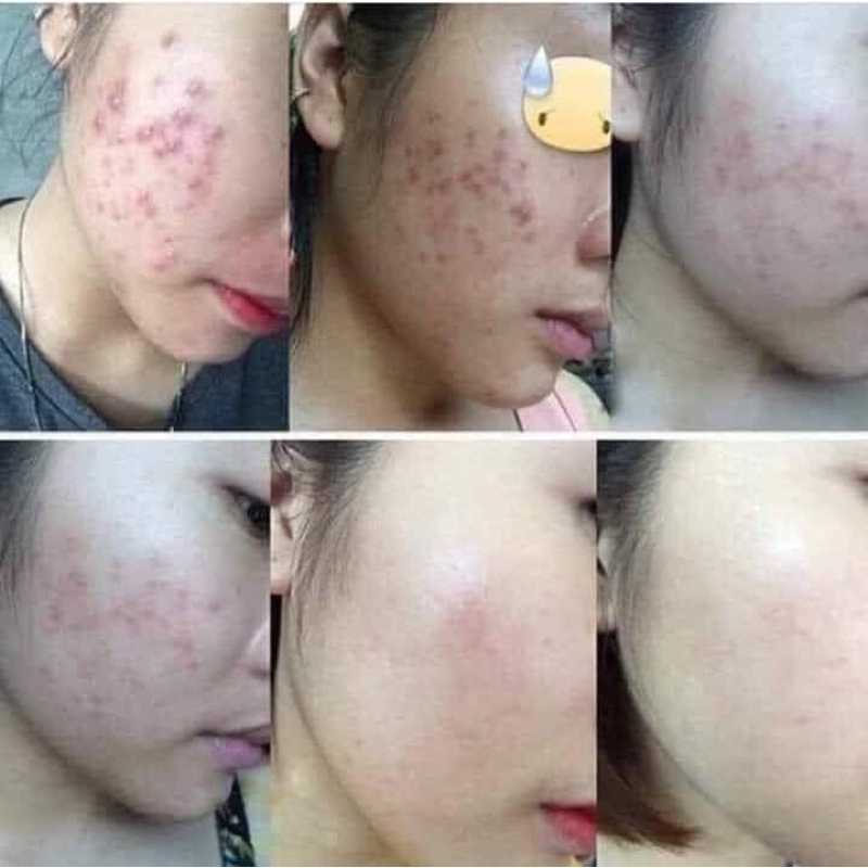 Ngừa mụn Lê Xuân🍀thảo dược đông y lê xuân🍀loại bỏ mụn trứng cá, mụn ẩn, mụn viêm,… | BigBuy360 - bigbuy360.vn