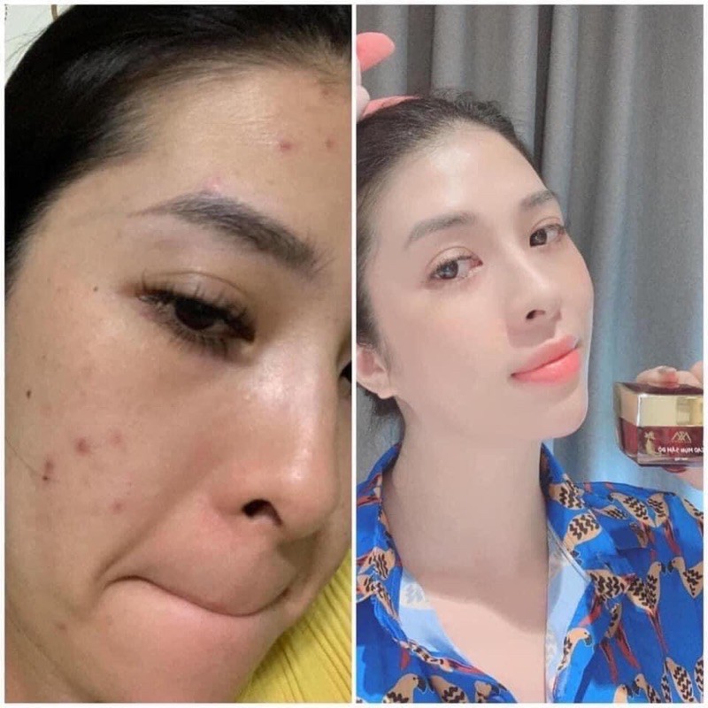 COMBO KHÁCH SỈ CAO MUN SAM DO LON 15GRAM