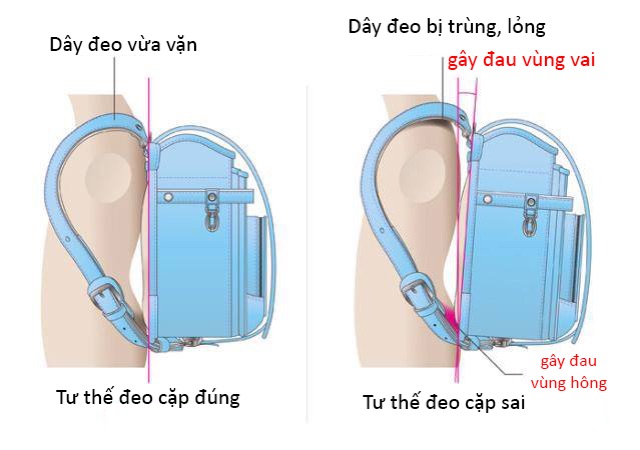 Cặp chống gù Nhật Bản khoá tự động xanh Ngọc