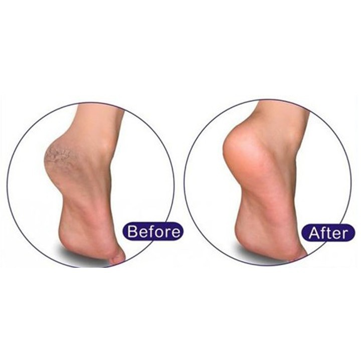 Kem gót chân Kpem Nga 50ml