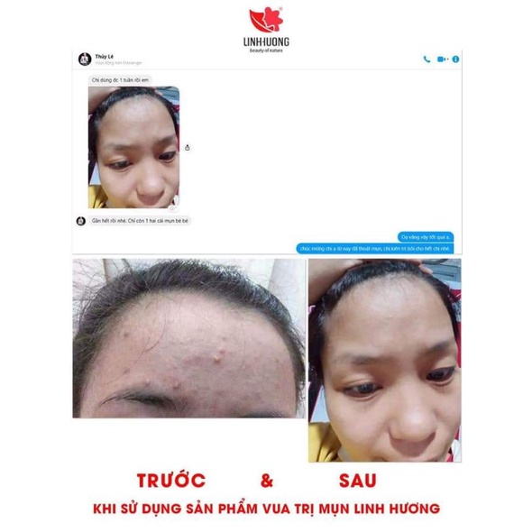 Serum đánh bay mụn 11day Linh Hương | BigBuy360 - bigbuy360.vn