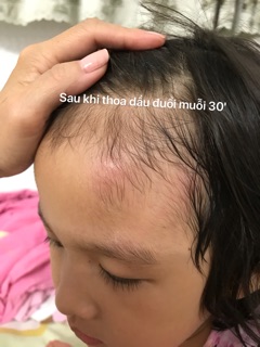 DẦU ĐUỔI MUỖI KIM