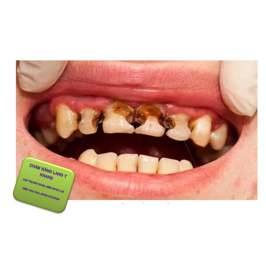 CHẤM SÂU RĂNG GIA TRUYỀN, hỗ trợ người VIÊM LỢI, VIÊM NHA CHU, SƯNG CÙI RĂNG