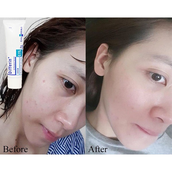 Gel giảm mụn Differin Acne Treatment Gel Adapalene Gel 0.1%