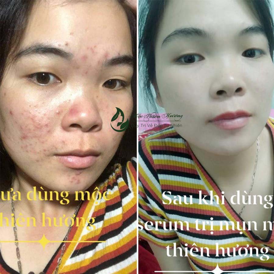 Combo Đánh Bay Nhanh Mụn Viêm, Mụn Ẩn, Mụn Trứng Cá, Mụn Đầu Đen Và Các Loại Mụn Khác Mộc Thiên Hương | BigBuy360 - bigbuy360.vn