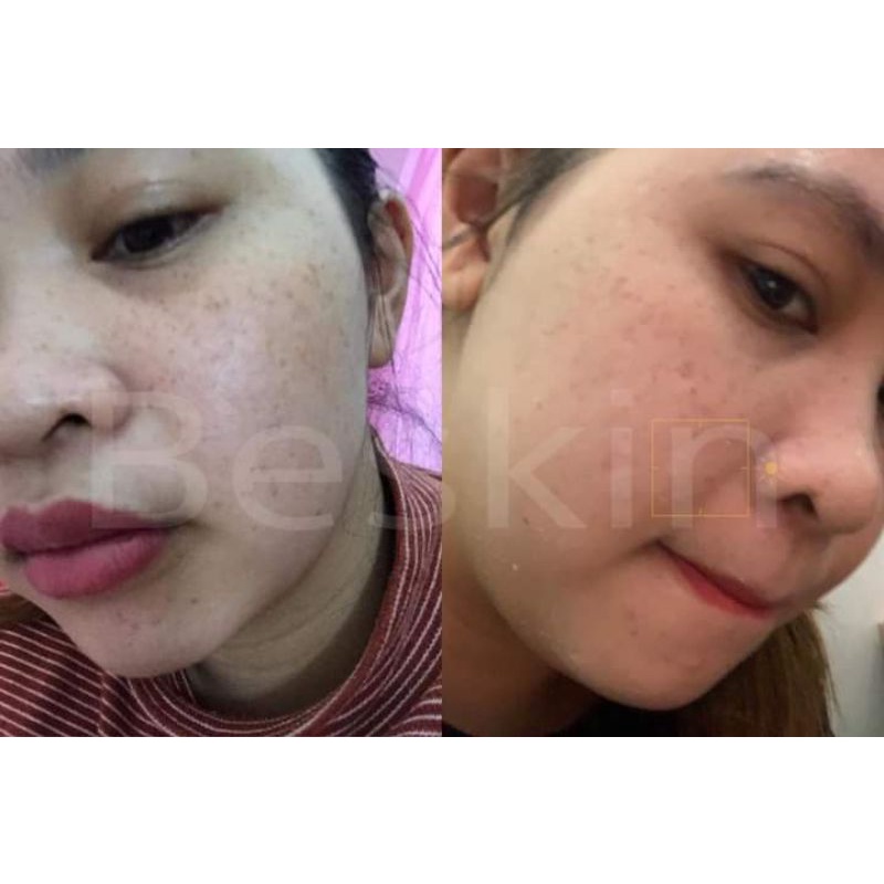 Kem Face nám tàn nhang da không đều màu