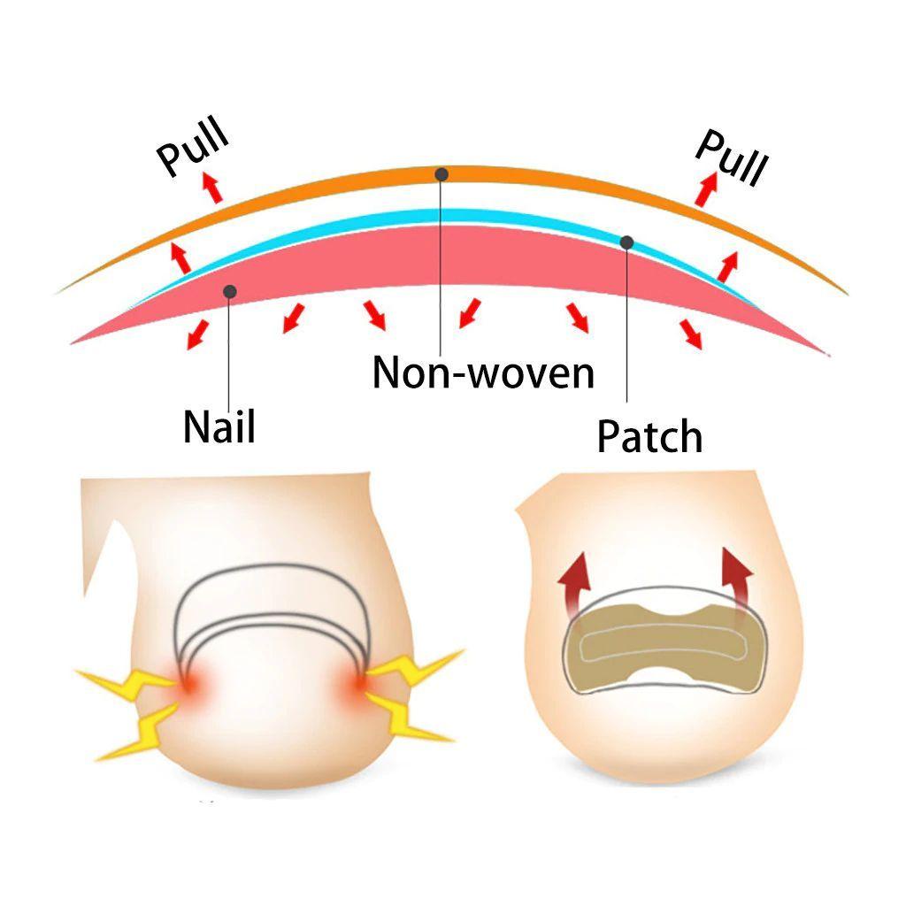 Miếng Dán Chỉnh Hình Móng Chân Không Cần Keo Chuyên Nghiệp