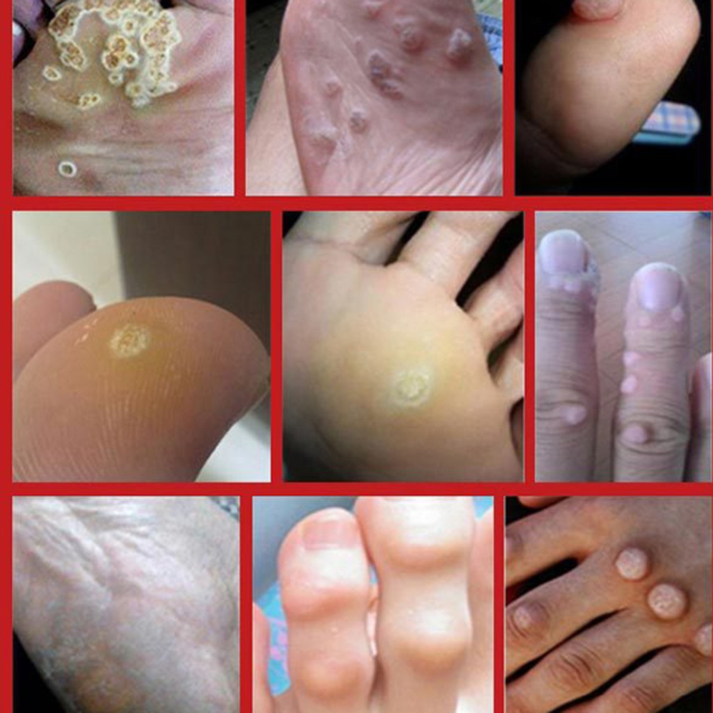 (Hàng Mới Về) Bộ 42 Miếng Dán Trị Mụn Cóc Chất Lượng Cao | BigBuy360 - bigbuy360.vn