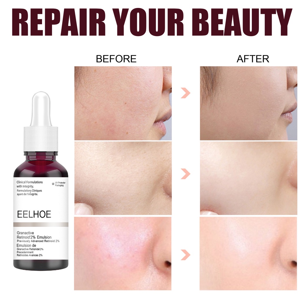 Tinh Chất Axit Salicylic Acid Trái Cây Tẩy Tế Bào Chết Dưỡng Ẩm Nuôi Dưỡng Da