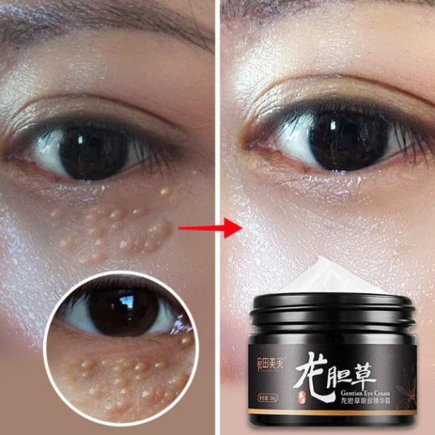 Kem mờ mụn thịt giảm thâm