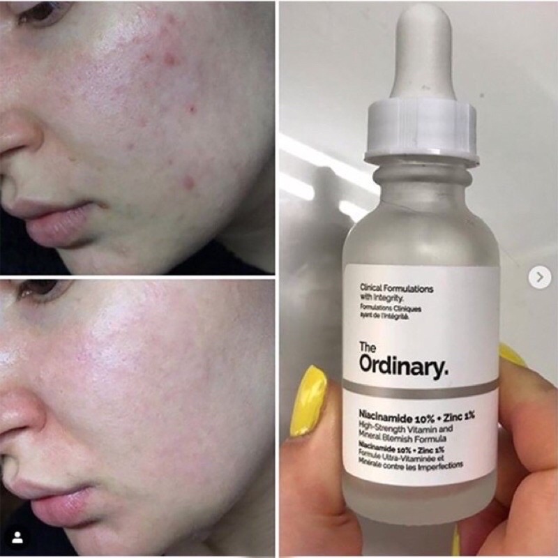 Tinh chất serum The Ordinary Niacinamide 10% + zin 1% 30ml