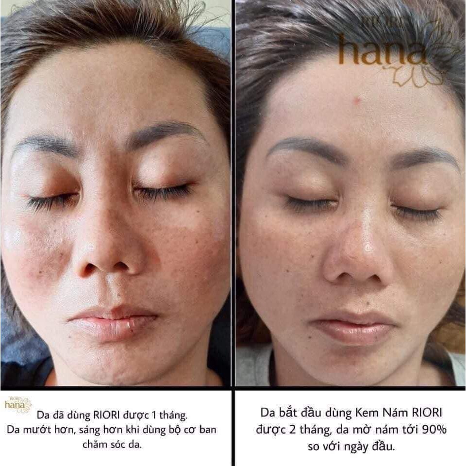 [FREESHIP] - KEM NÁM  RIORI MELASMA COLLAGEN HANA 30GR GIÚP CHỐNG KHÔ PHỂ