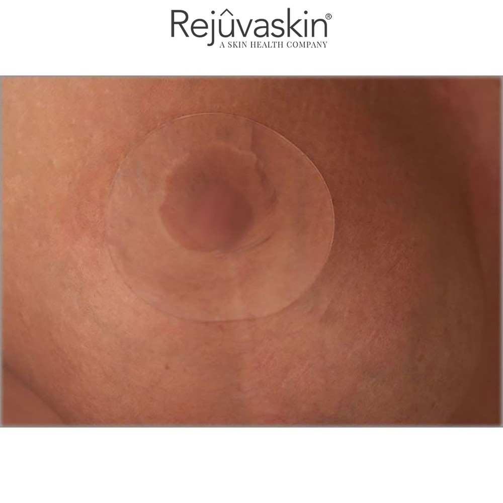 Miếng dán xóa mờ sẹo phẫu thuật ngực Rejuvaskin Scar FX Breast Circle 3″