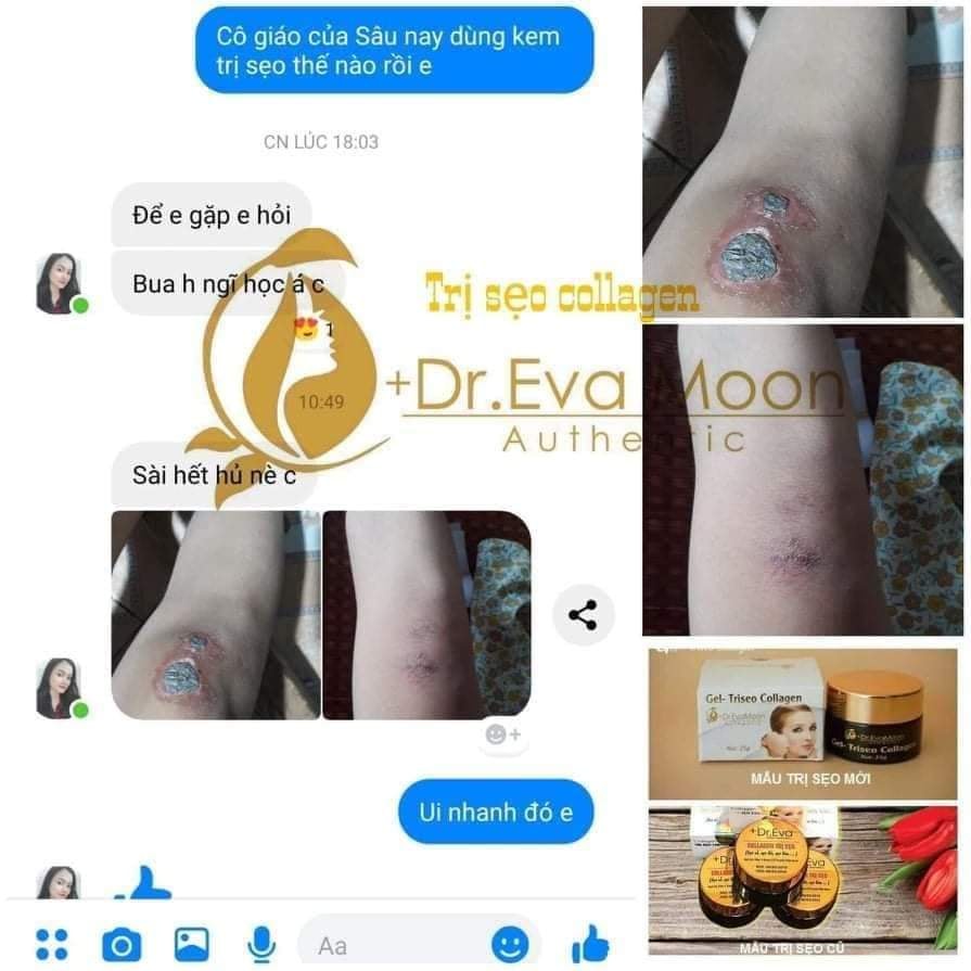Kem mờ sẹo Gentacin, làm mờ sẹo lồi, sẹo rỗ, sẹo thâm EVA